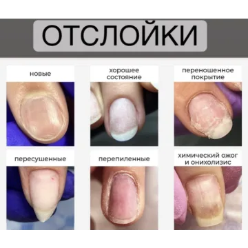 Отслойки (Вельмитина Зайцева)