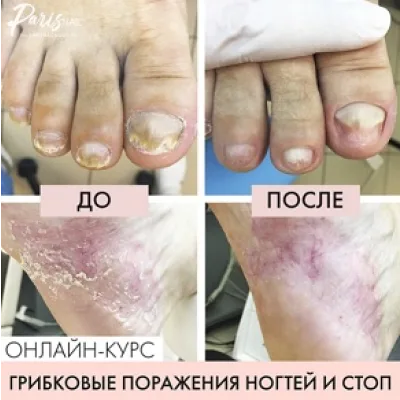 [parisnail] Грибковое поражение ногтей и кожи стоп (Карина Шурыгина)